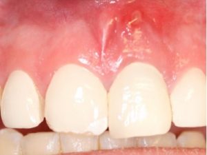 Dental Abscess