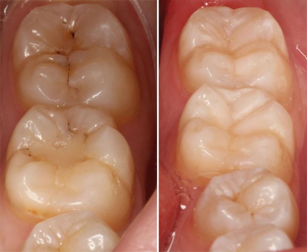 What are Cavities? - Best Dentist Staten Island