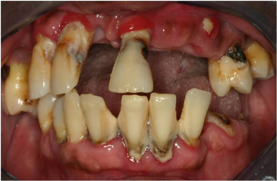 Full Mouth Rehabilitation-01