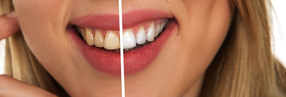 Best Lumineers dentists veneers