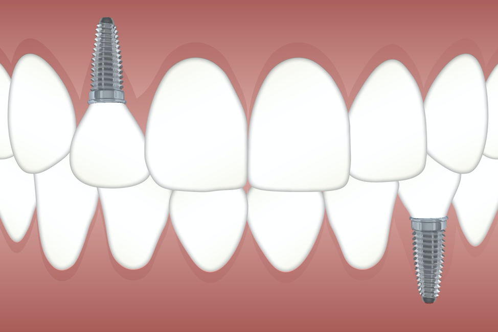 Best Tooth Implant Dentist | Staten Island, NY