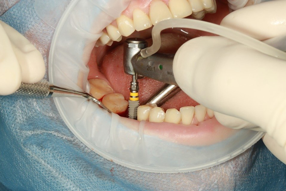 All about dental implants