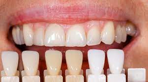 Dental Veneers | Staten Island Dentist