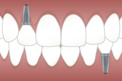 Dental Implants 2022