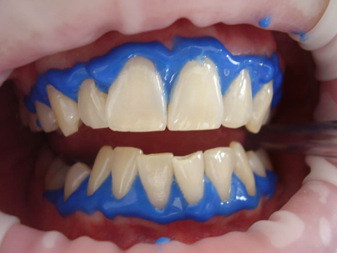 Professional Teeth Whitening Dentists