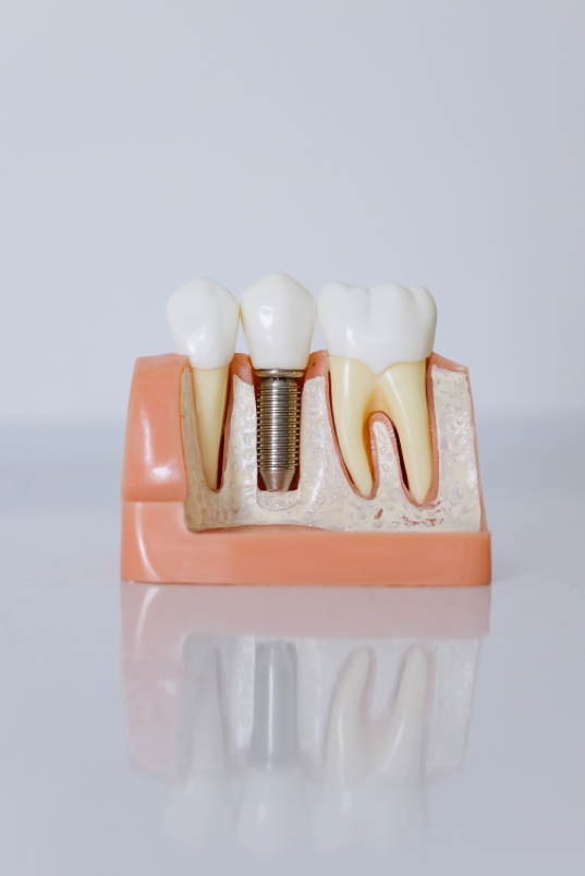 When Should You Remove a Tooth?