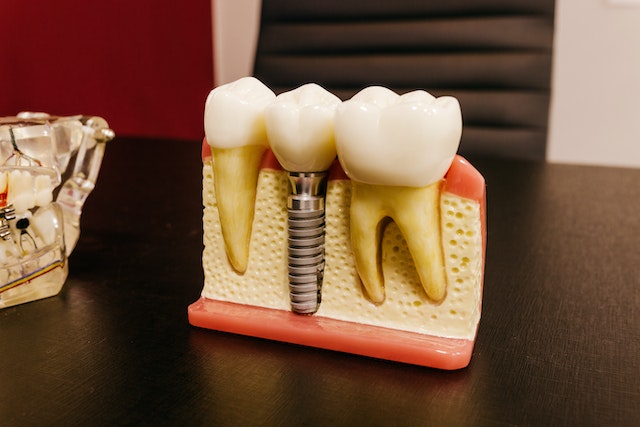 Benefits of Dental Implants 2023