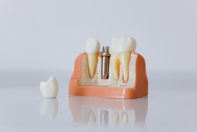 Dental Implants vs. Dentures-implants