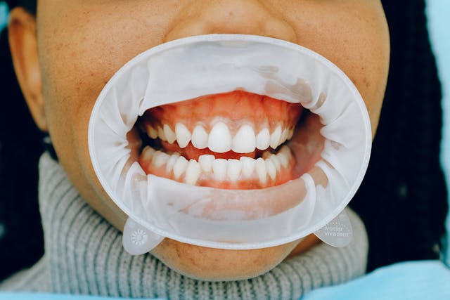 Understanding Gum Disease-periodontis info staten island dentist