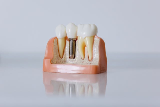Dental Implants and Dentures-best implants staten island